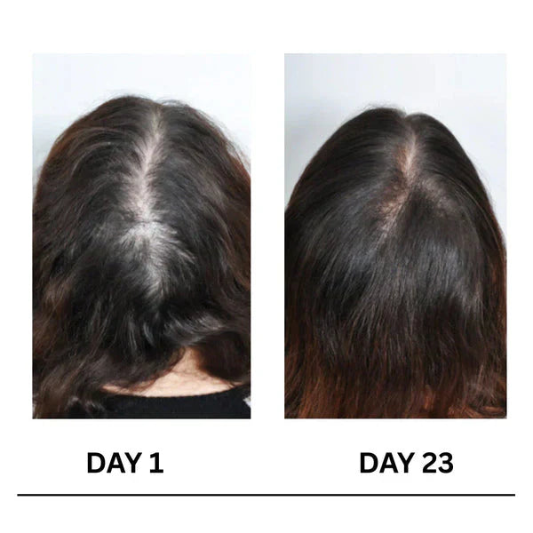🔥Limited-Time Offer Scalpy Boost+ Hair Growth-4