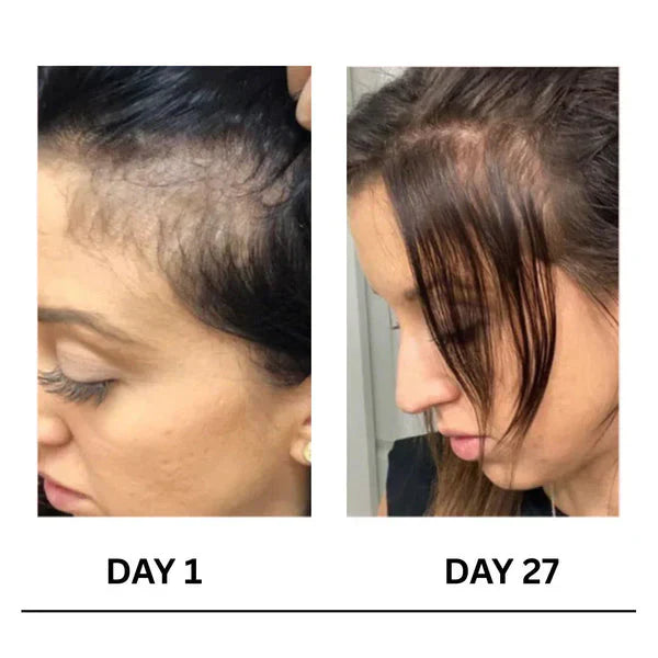 🔥Limited-Time Offer Scalpy Boost+ Hair Growth-5