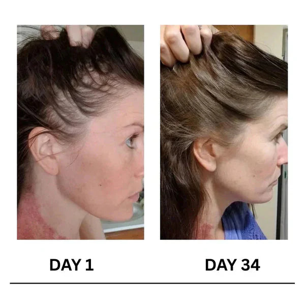 🔥Limited-Time Offer Scalpy Boost+ Hair Growth-6