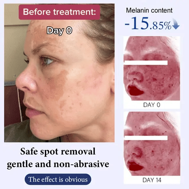 Whitening and Spot-Removing Cream💦-6