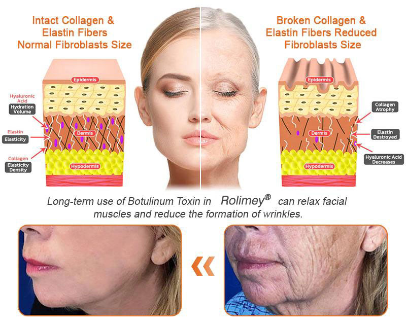 🧑‍⚕️𝑶𝒇𝒇𝒊𝒄𝒊𝒂𝒍 𝑺𝒕𝒐𝒓𝒆 | 𝐑𝐨𝐥𝐢𝐦𝐞𝐲® 𝐁𝐨𝐭𝐨𝐱 𝐁𝐞𝐞 𝐕𝐞𝐧𝐨𝐦 𝐅𝐢𝐫𝐦𝐢𝐧𝐠 𝐒𝐞𝐫𝐮𝐦 𝐒𝐭𝐢𝐜𝐤 - 𝐓𝐚𝐫𝐠𝐞𝐭𝐬 𝐒𝐚𝐠𝐠𝐢𝐧𝐠 𝐒𝐤𝐢𝐧 & 𝐖𝐫𝐢𝐧𝐤𝐥𝐞𝐬 𝐀𝐥𝐥 𝐎𝐯𝐞𝐫 𝐁𝐨𝐝𝐲 𝐰𝐢𝐭𝐡 𝐀𝐝𝐯𝐚𝐧𝐜𝐞𝐝 𝐏𝐞𝐩𝐭𝐢𝐝𝐞 𝐓𝐞𝐜𝐡𝐧𝐨𝐥𝐨𝐠𝐲, 𝐕𝐢𝐬𝐢𝐛𝐥𝐞 𝐑𝐞𝐬𝐮𝐥𝐭𝐬 𝐢𝐧 𝟑 𝐃𝐚𝐲𝐬-7
