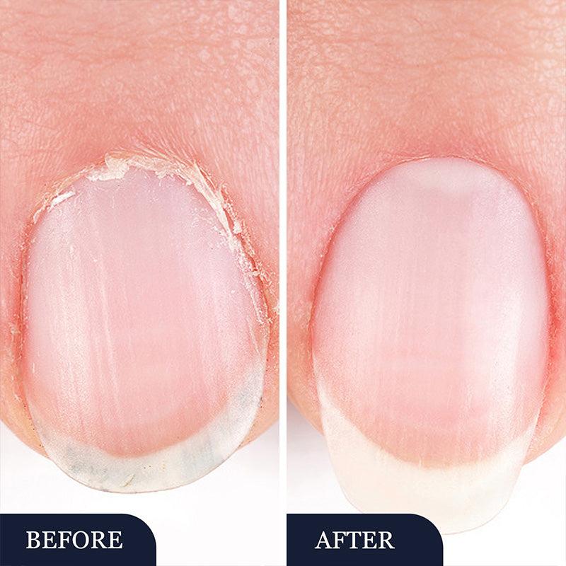 🖤2026 New Year · 40% OFF🖤Toenail Fungus Treatment Pen for Damaged Nails-2