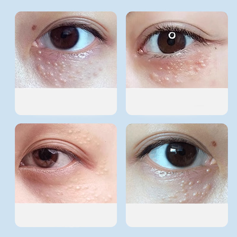 Advanced Milia Remover Serum-4